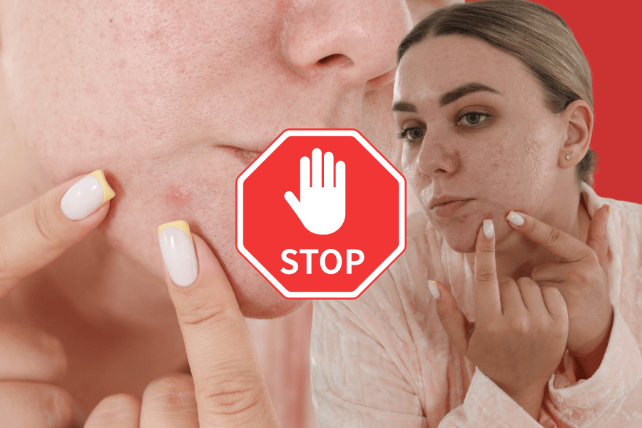 Stop Popping Pimples