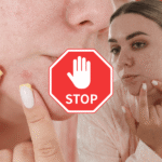 7 reasons to stop popping pimples — and what to do instead (dermatologist-approved)