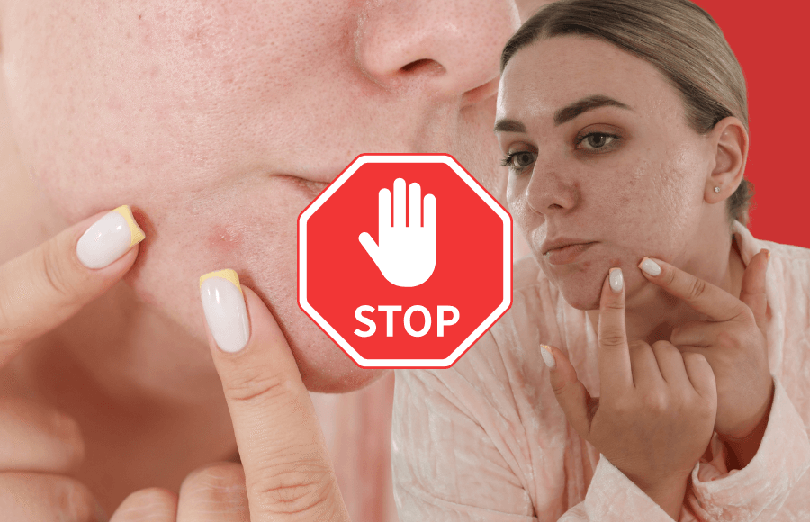 7 reasons to stop popping pimples — and what to do instead (dermatologist-approved)