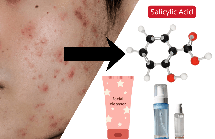 Best Salicylic Acid Cleanser for Acne — Find the Right One for Your Skin Type