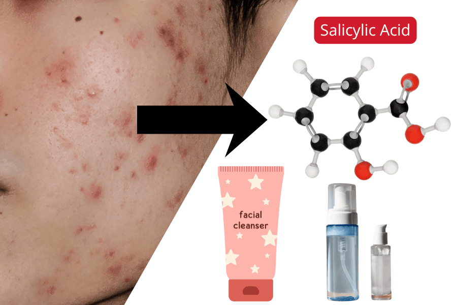 Best Salicylic Acid Cleanser for Acne — Find the Right One for Your Skin Type