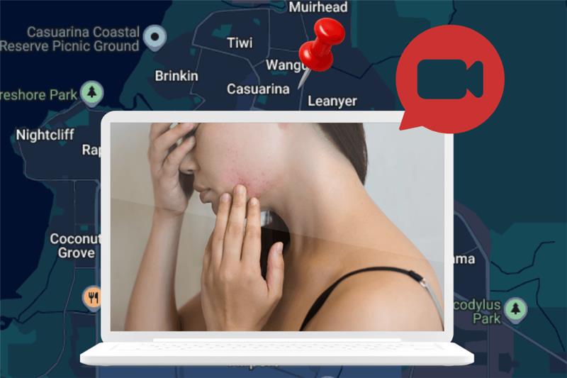 Acne treatment Darwin Casuarina