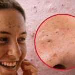 Black pimples: causes, types, and when to see a skin doctor online