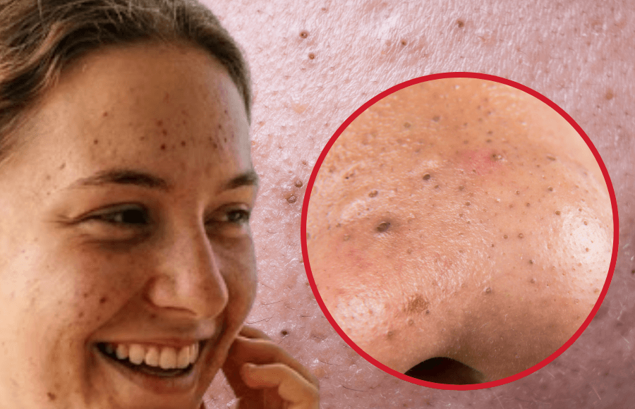 Black pimples: causes, types, and when to see a skin doctor online