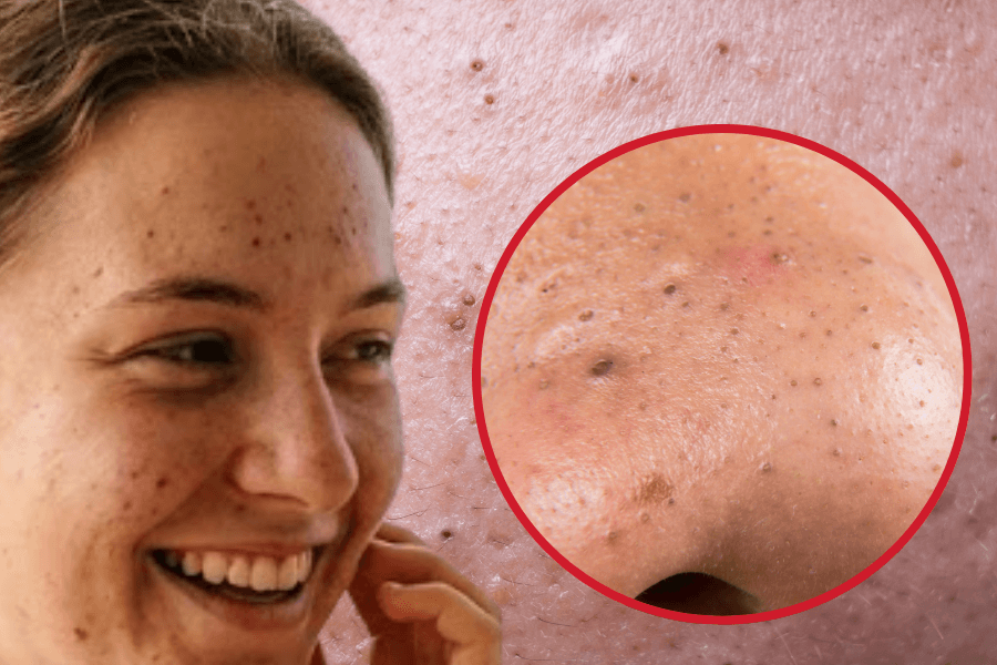 Black pimples: causes, types, and when to see a skin doctor online