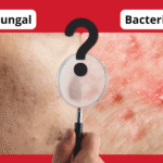 Fungal vs Bacterial Acne: Why Getting the Diagnosis Right Matters