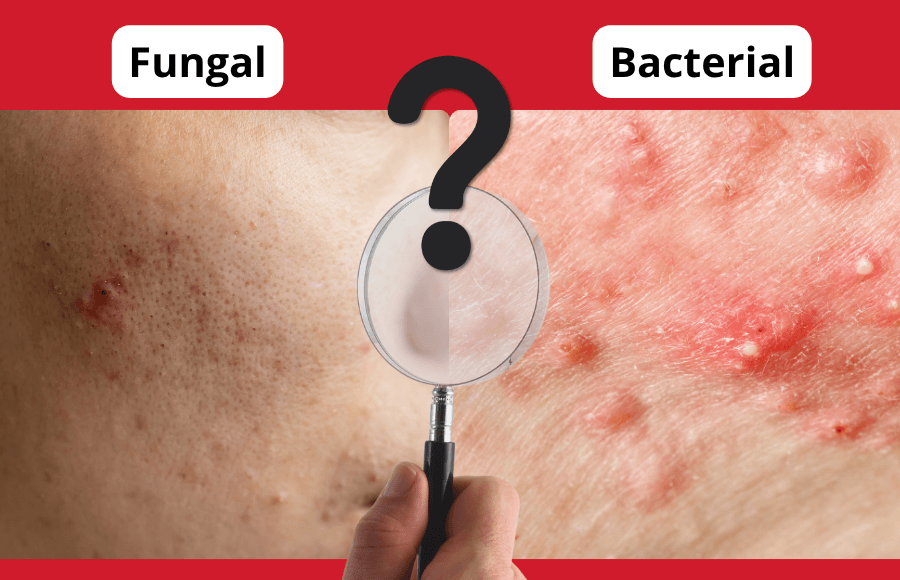 Fungal vs Bacterial Acne: Why Getting the Diagnosis Right Matters
