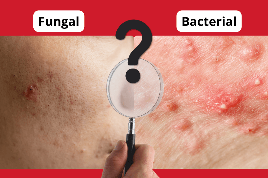 Fungal vs Bacterial Acne: Why Getting the Diagnosis Right Matters