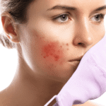 Maskne What It Is, Why It Happens, and How to Finally Get Rid of It (1) Maskne: What It Is, Why It Happens, and How to Finally Manage It