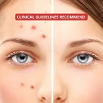 Evidence-based acne treatment what clinical guidelines recommend Evidence-based acne treatment: what clinical guidelines recommend