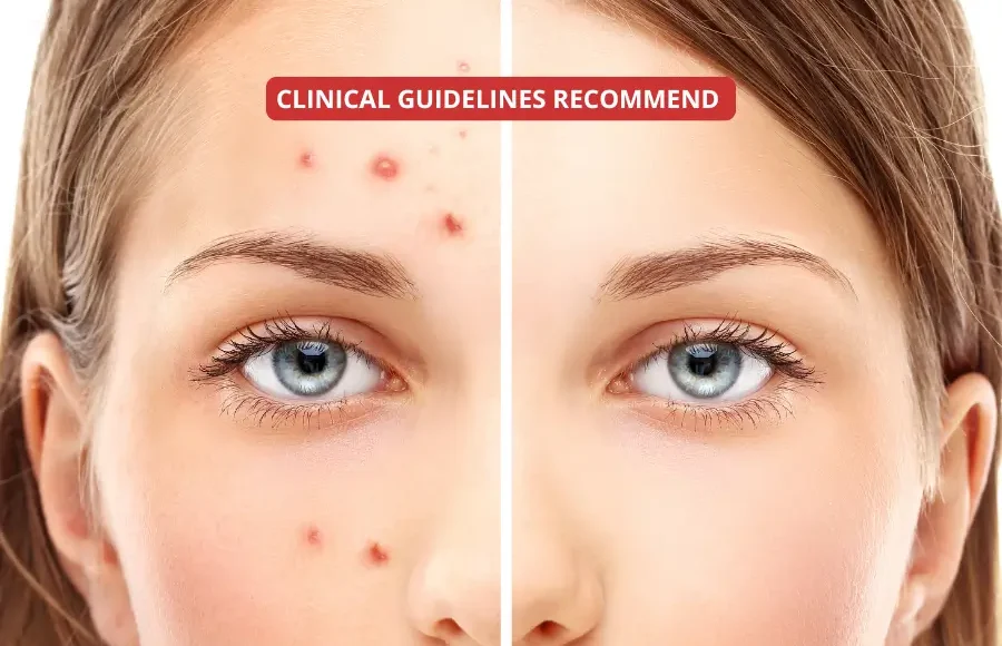 Evidence-based acne treatment: what clinical guidelines recommend