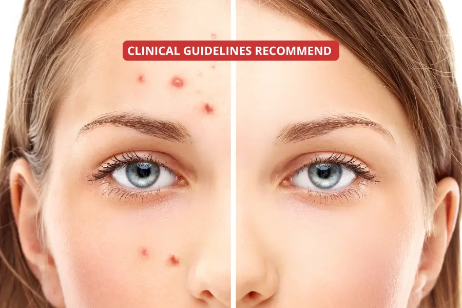 Evidence-based acne treatment: what clinical guidelines recommend