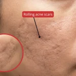 Rolling acne scars: causes, types, and clinical treatment options