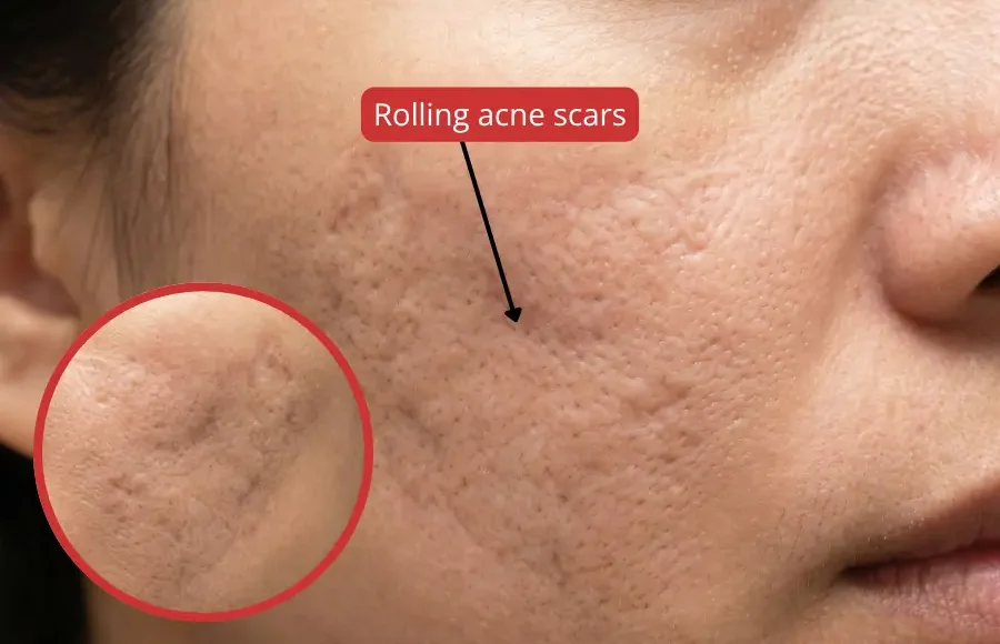 Rolling acne scars: causes, types, and clinical treatment options