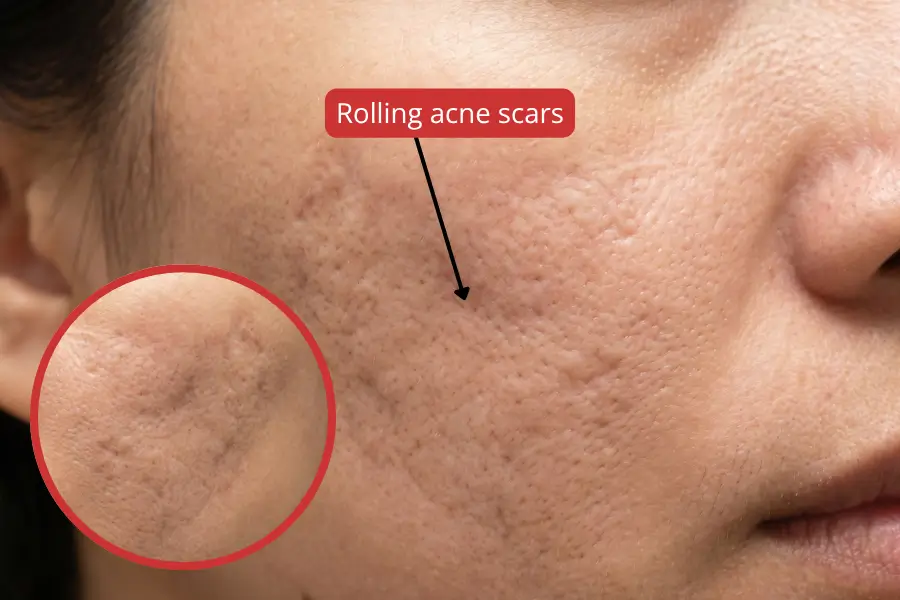 Rolling acne scars: causes, types, and clinical treatment options