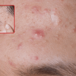 Tiny little acne bumps on forehead causes, types, and treatment options Tiny little acne bumps on forehead: causes, types, and treatment options
