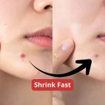 How to Shrink a Blind Pimple Fast — and Stop Making It Worse