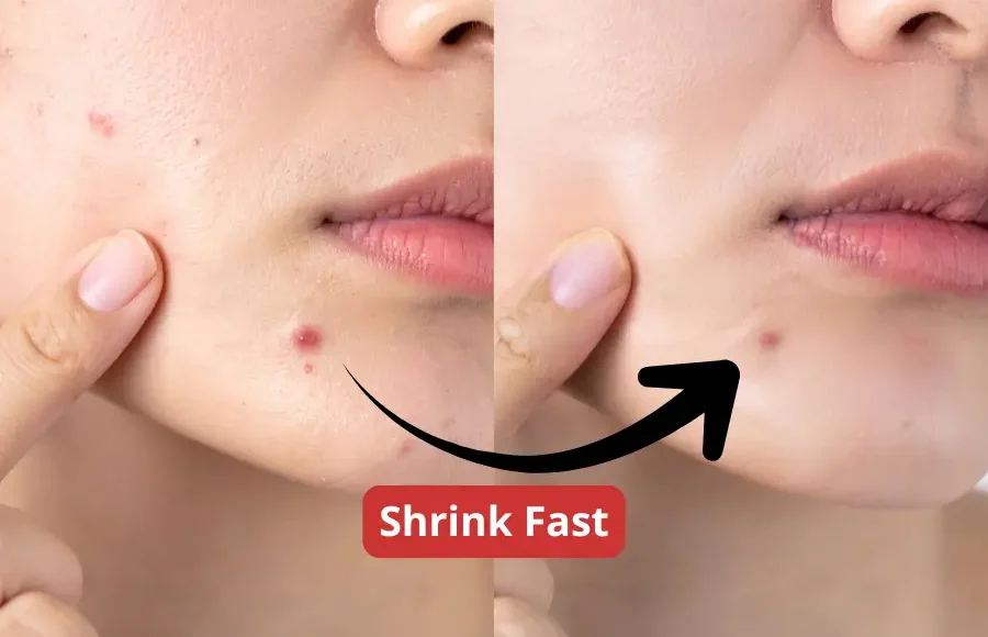 How to Shrink a Blind Pimple Fast — and Stop Making It Worse