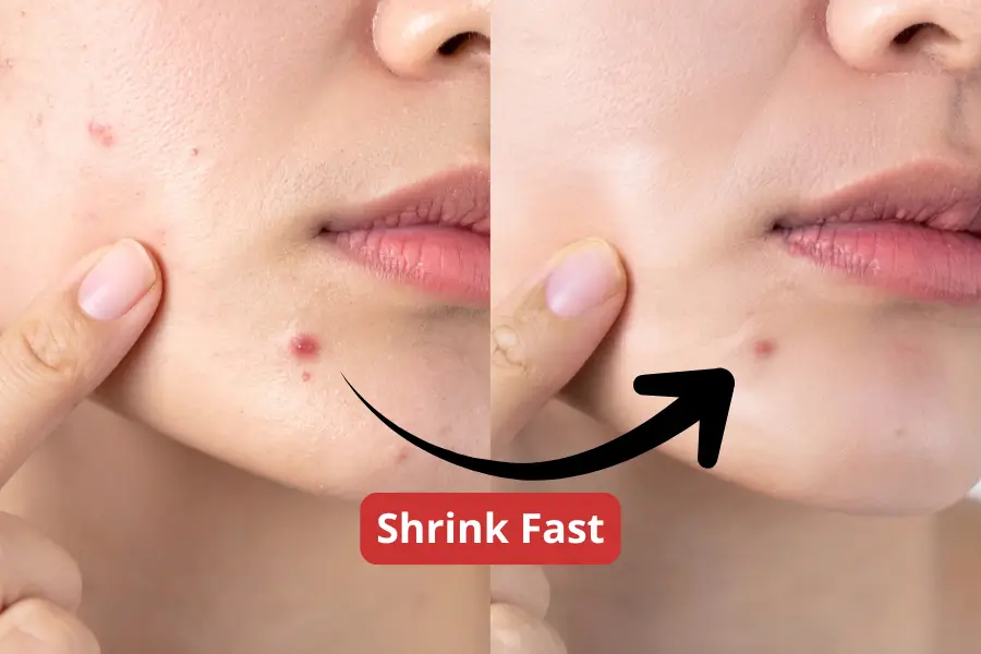 How to Shrink a Blind Pimple Fast — and Stop Making It Worse