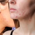 Jawline Hormonal Acne Why It Happens and How to Clear It for Good Jawline Hormonal Acne: Why It Happens and How to Clear It for Good