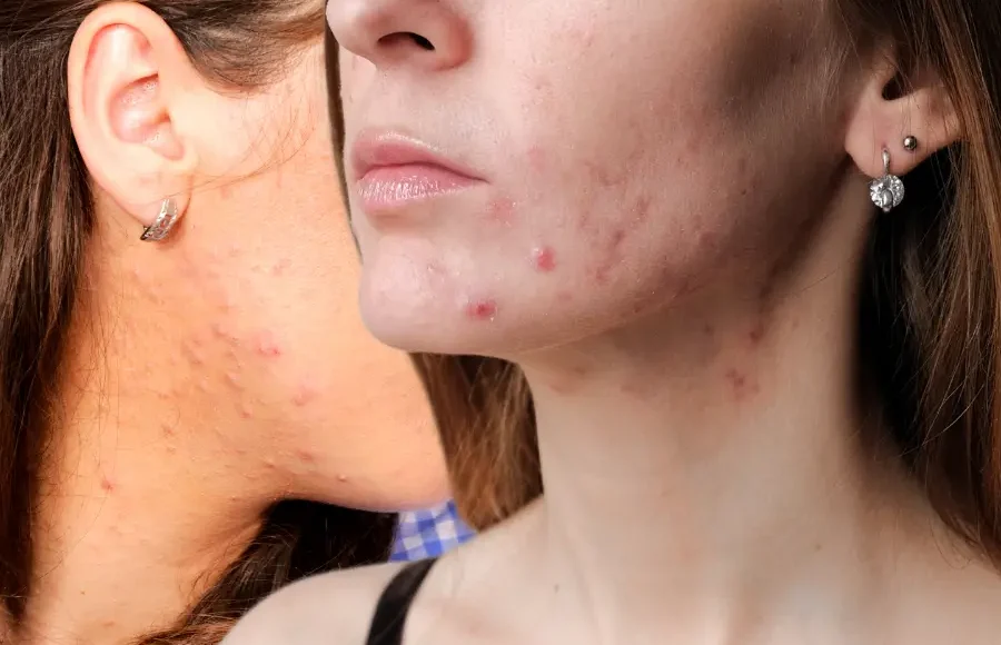 Jawline Hormonal Acne: Why It Happens and How to Clear It for Good