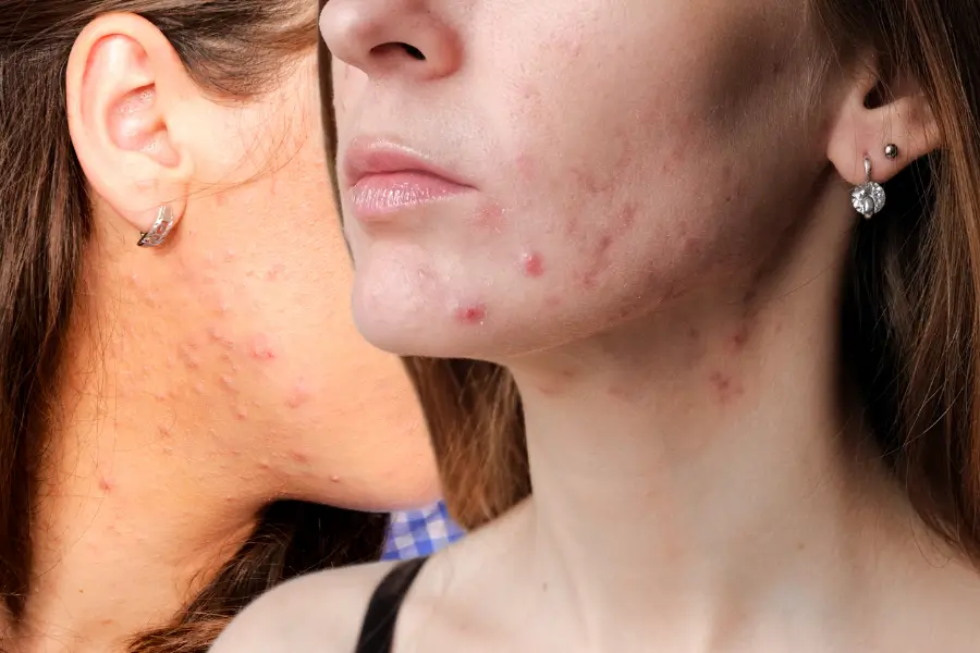 Jawline Hormonal Acne: Why It Happens and How to Clear It for Good