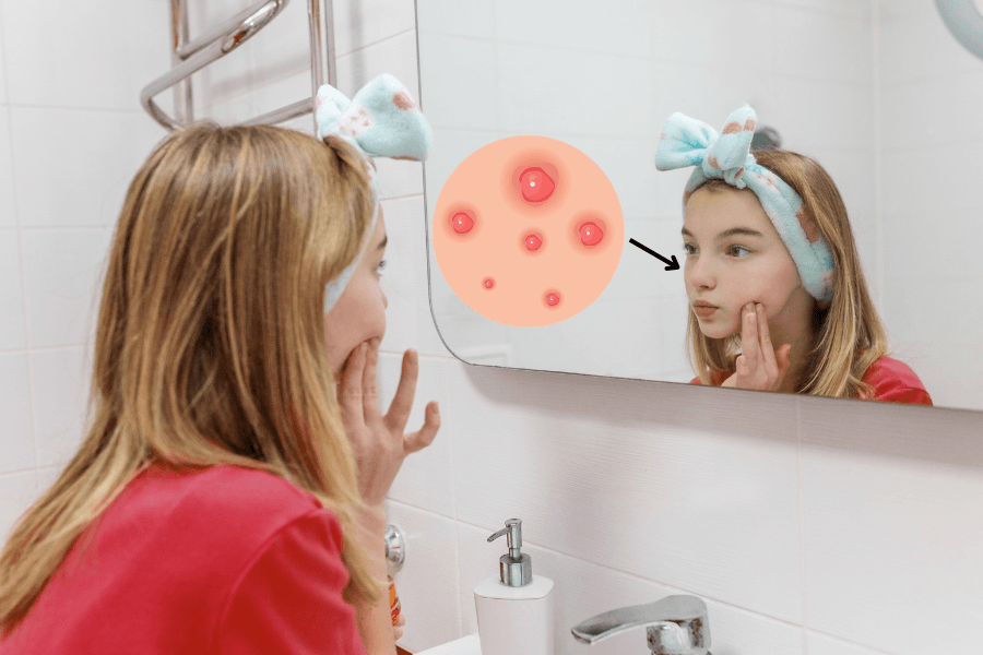 Teenage acne causes: what's really behind your teen's breakouts