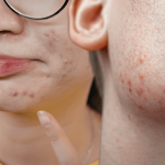 What causes face blemishes? Common triggers and how to treat them