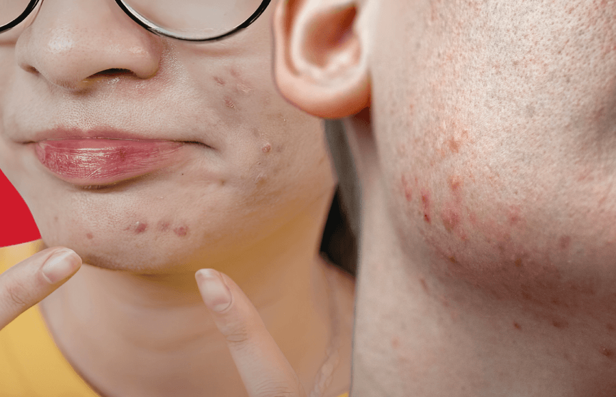 What causes face blemishes? Common triggers and how to treat them