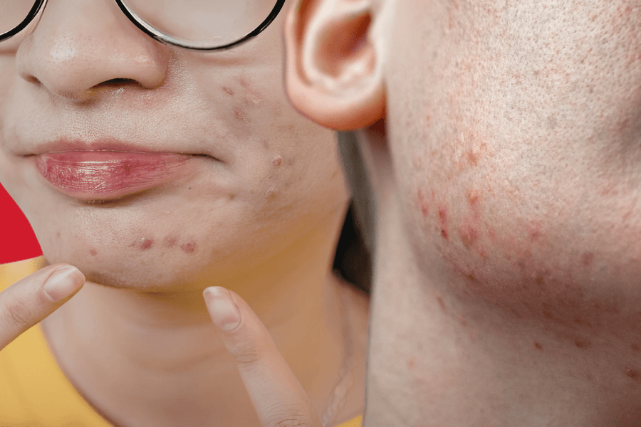 What causes face blemishes? Common triggers and how to treat them
