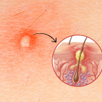 Infected Pimple: Causes, Symptoms, and How to Treat It Safely